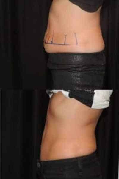 HIEMT Muscle Toning West Sussex