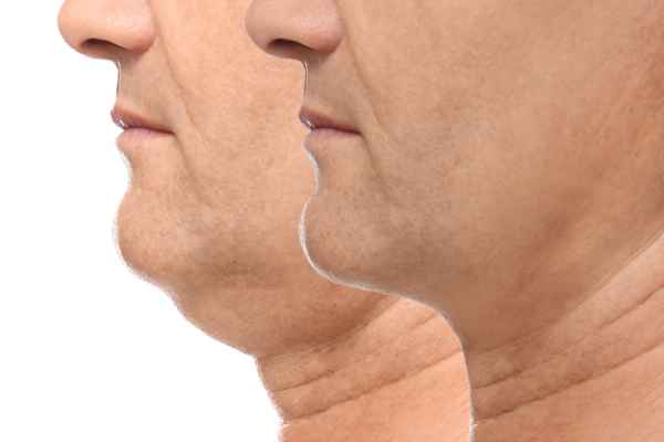 HIFU - Breakthrough in Anti - ageing 2 hifu results West Sussex