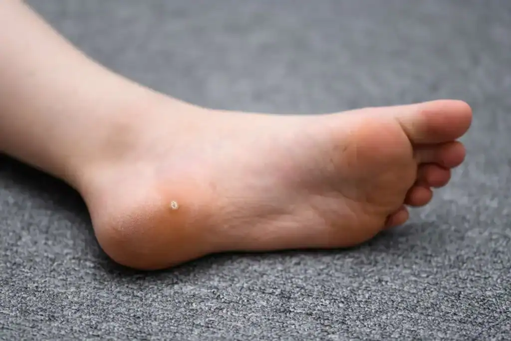 Cryotherapy For Warts And Also Verrucas 2 Image of verruca on the bottom of the foot that able to be treated with Cryotherapy West Sussex