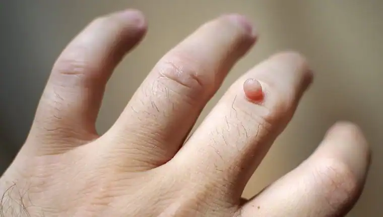 Cryotherapy For Warts And Also Verrucas 1 Image of blemish that Cryotherapy West Sussex can remove with Lipo 360.