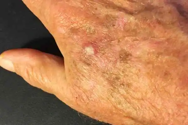 Image of Actinic keratoses West Sussex on a person hand