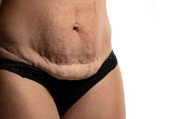 The Science of Skin Tightening 1 The science behind skin tightening West Sussex picture of a woman's sagging skin on the stomach